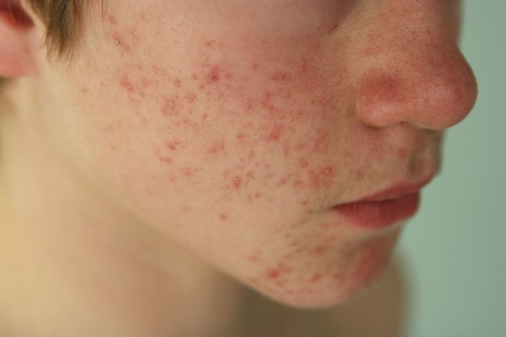 The Common Signs And Symptoms Of Acne