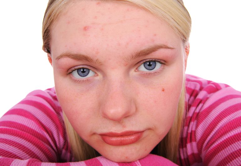 Identifying and Treating Mild Acne