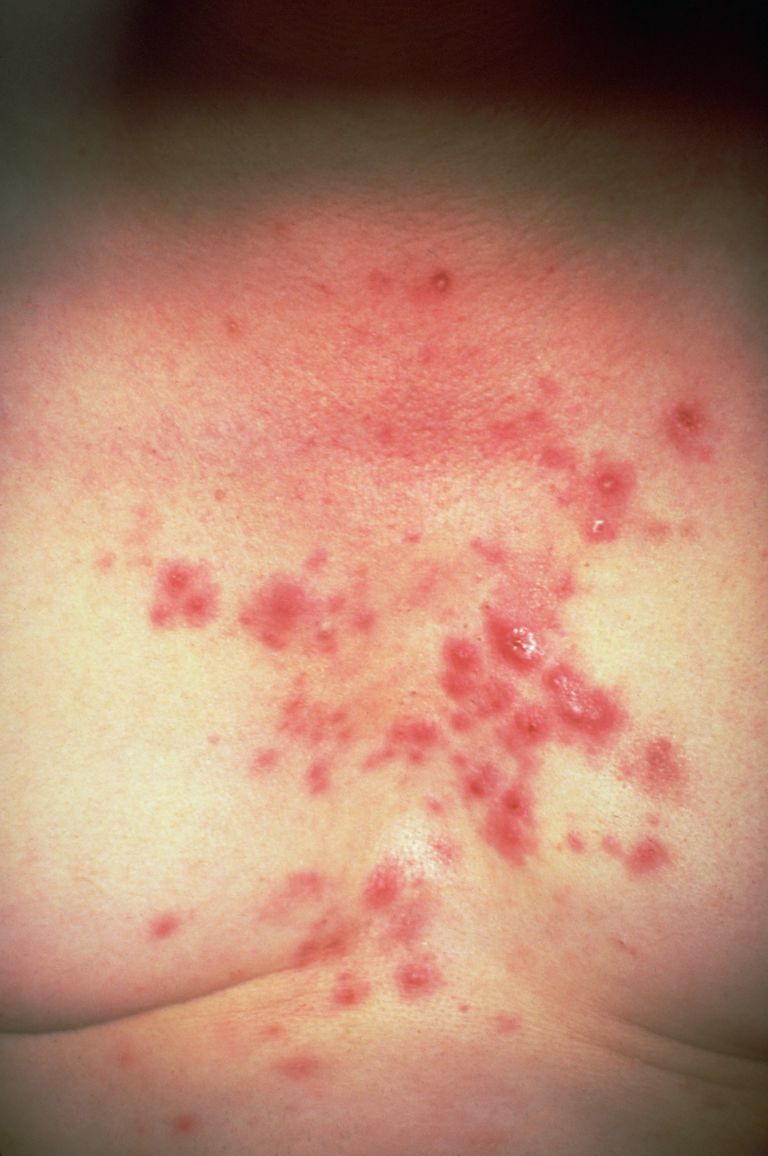 nodular-acne-what-causes-it-and-how-to-treat-it