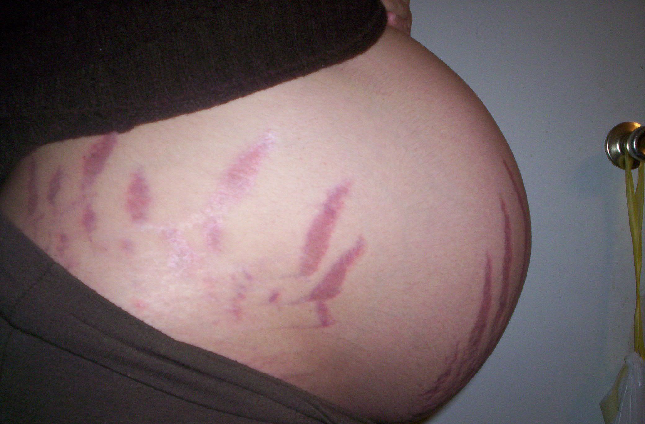 pregnancy-stretch-marks-photo-gallery