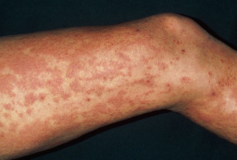 overview-of-hives-or-urticaria