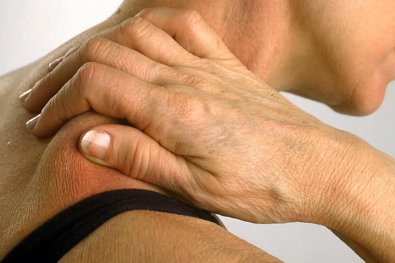 Заболевание мышц рук. Полимиозит и дерматомиозит. Рука на плече.