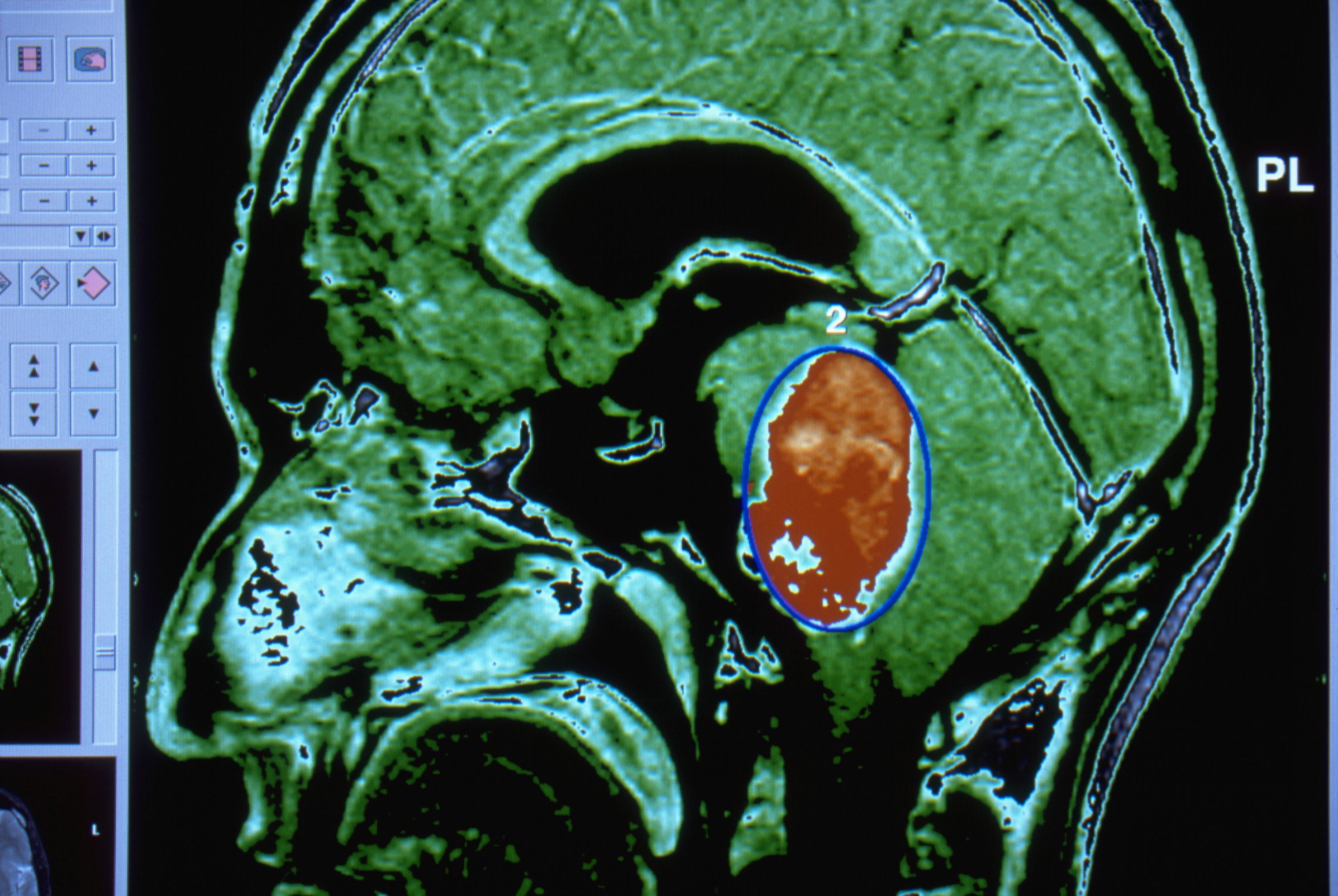 glioma-and-brain-cancer-treatments