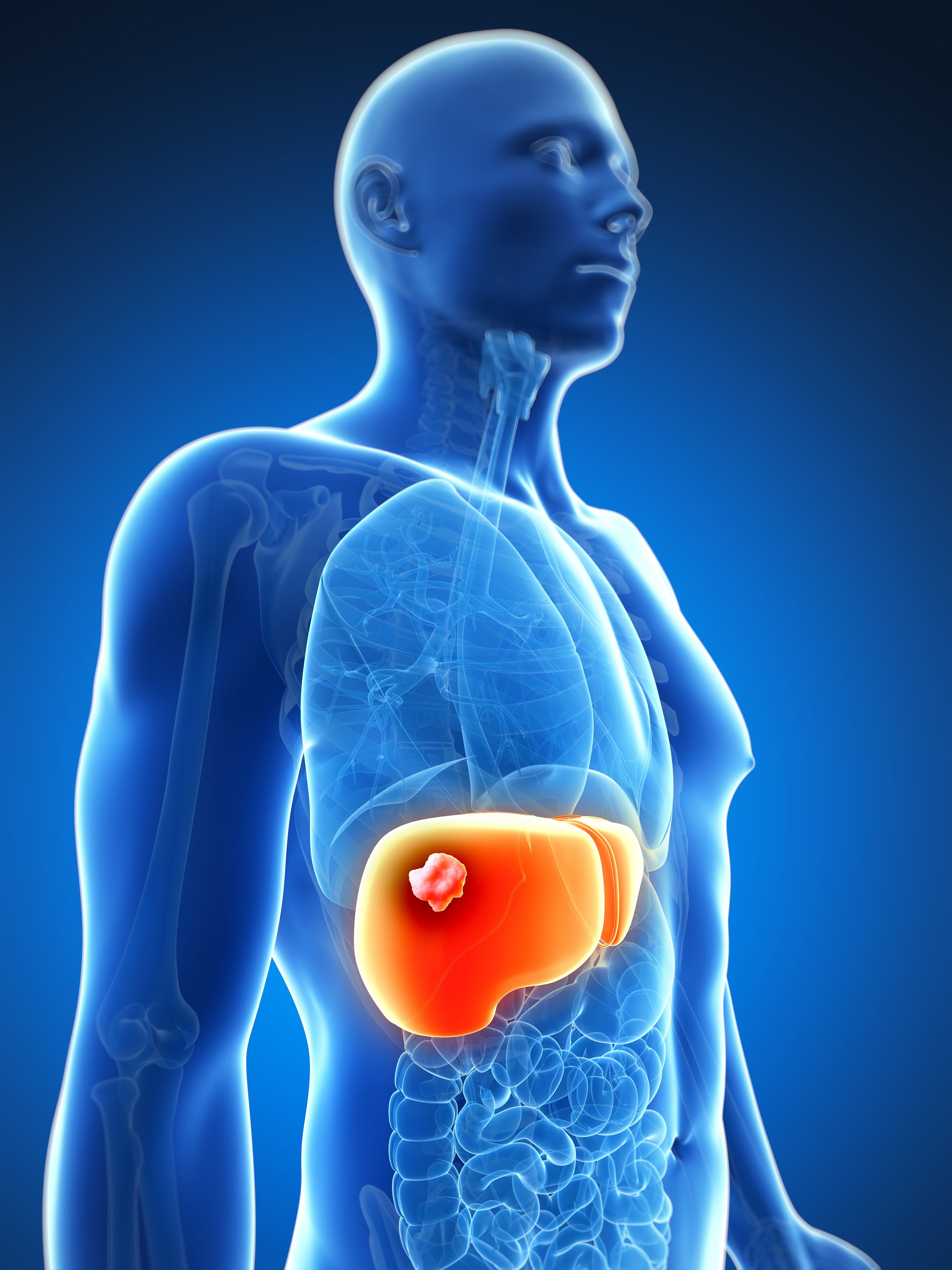 Causes Symptoms And Treatment Of Liver Cancer