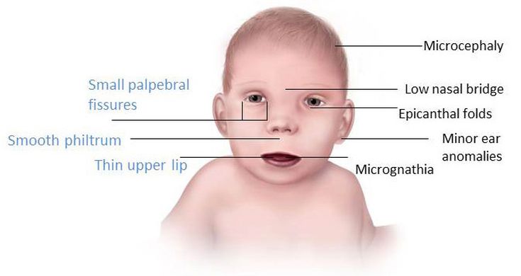 Fetal Alcohol Syndrome Frequently Asked Questions