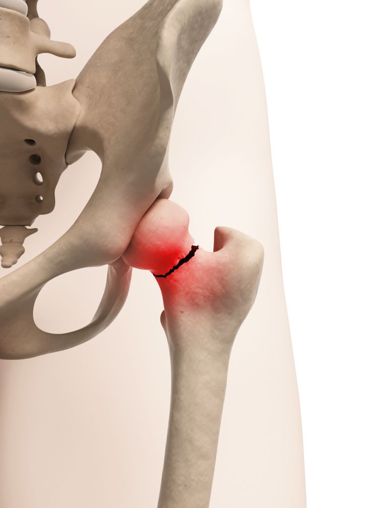 femoral neck hip fracture