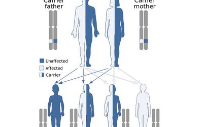 What Is Primordial Dwarfism?