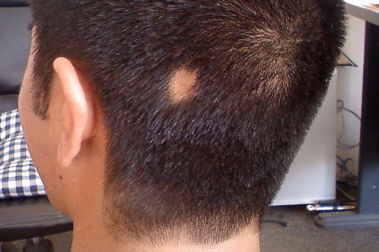 spot treatment z skin acne Help? Can Remedies Alopecia for Areata Natural   Treatments