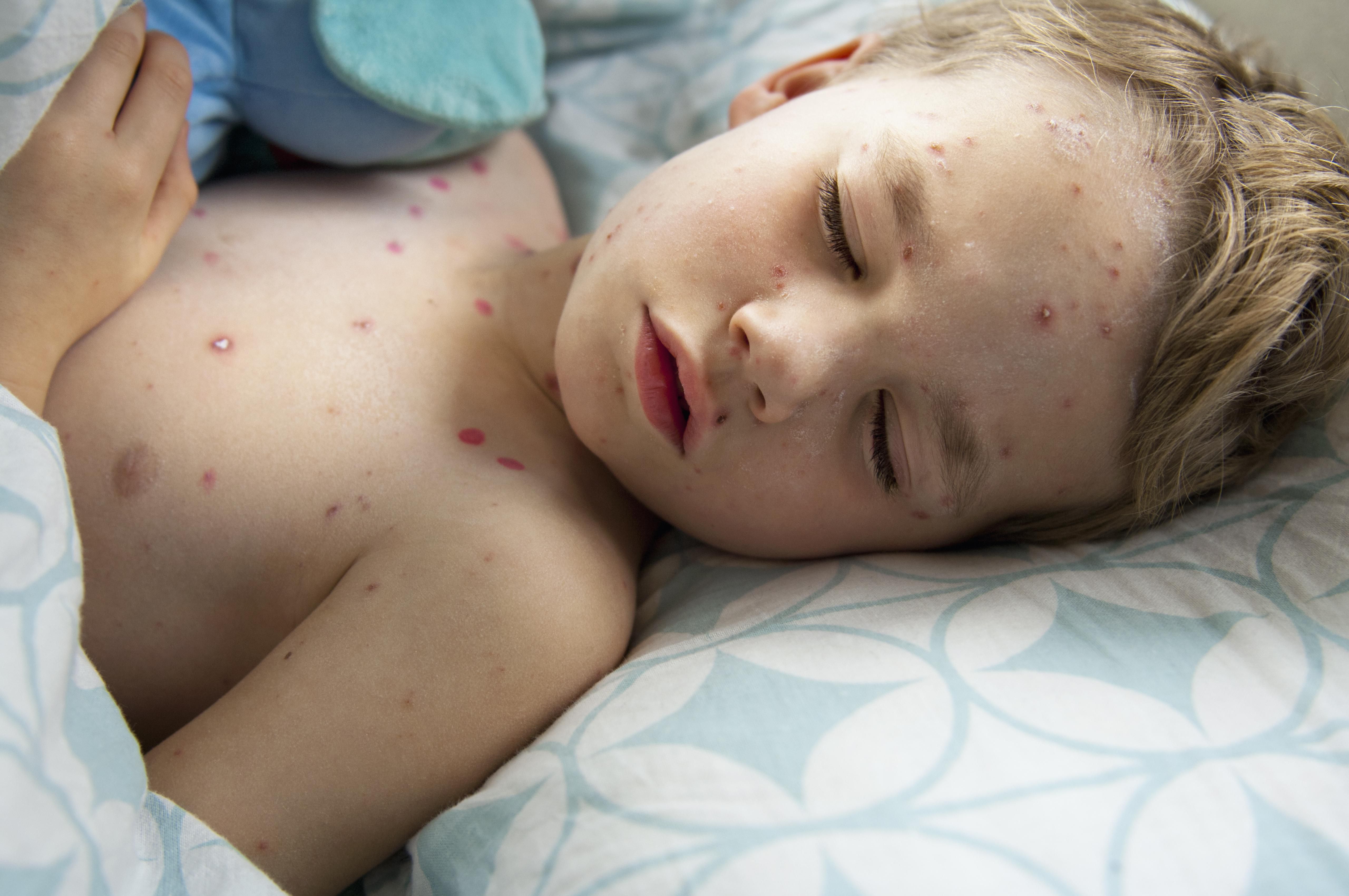 Chickenpox Symptoms Causes Diagnosis And Treatment