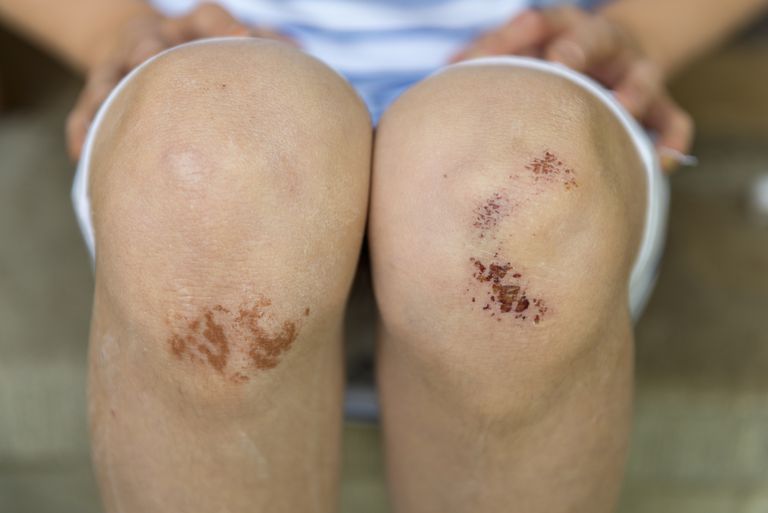 treat-road-rash-and-abrasive-injuries