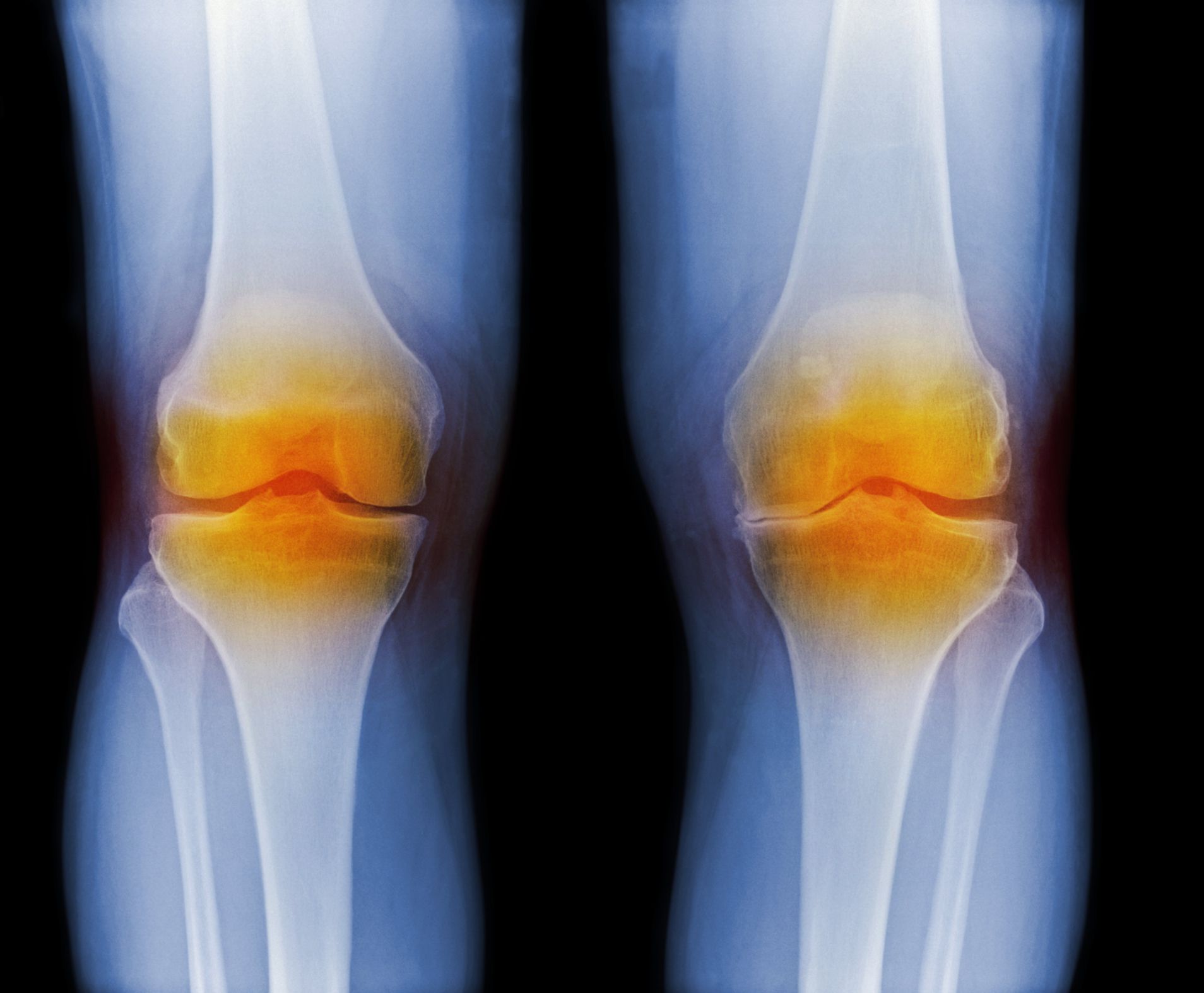 Supartz Injection For Knee Osteoarthritis