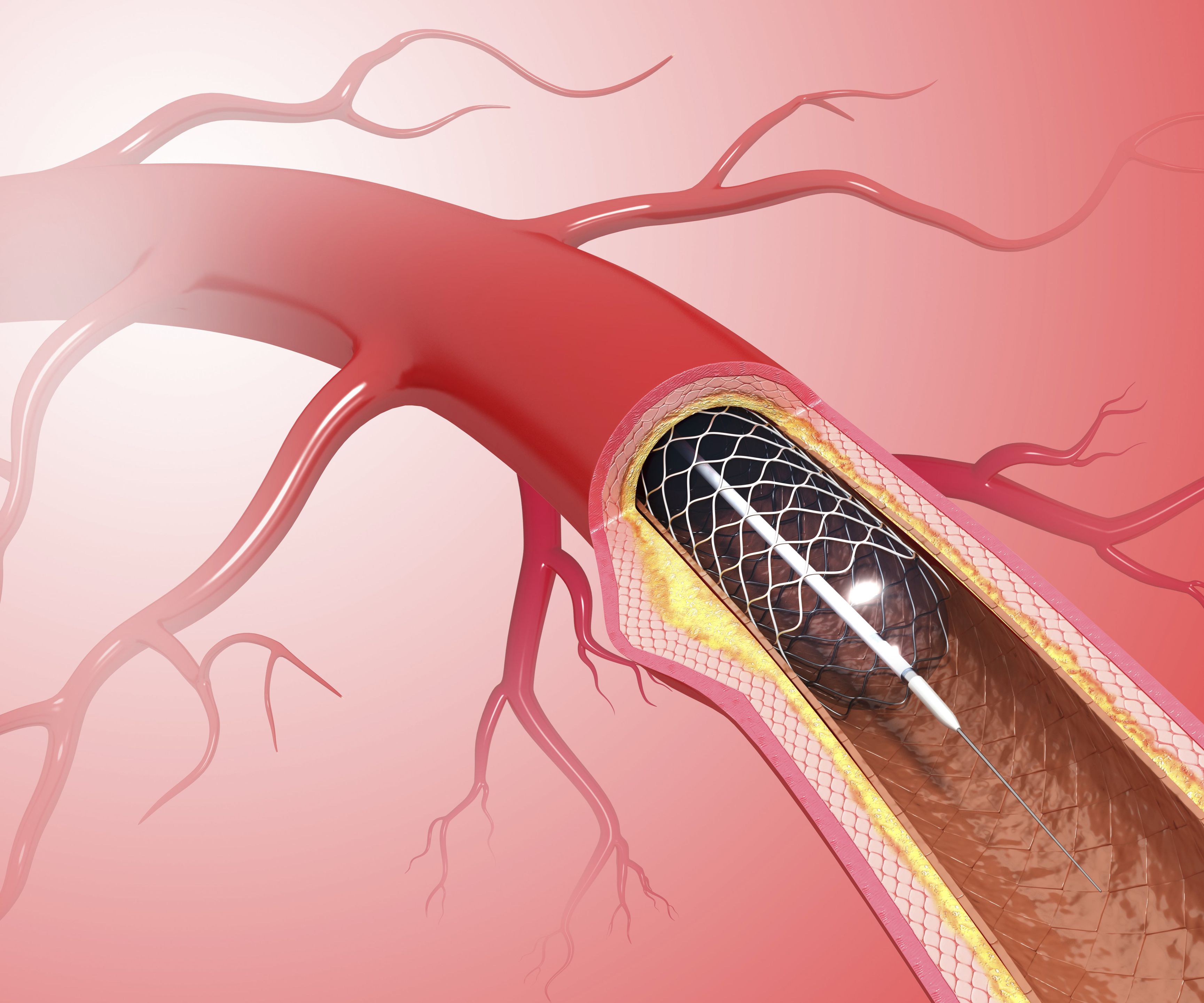 What Food Is Good For Heart Stent Patients