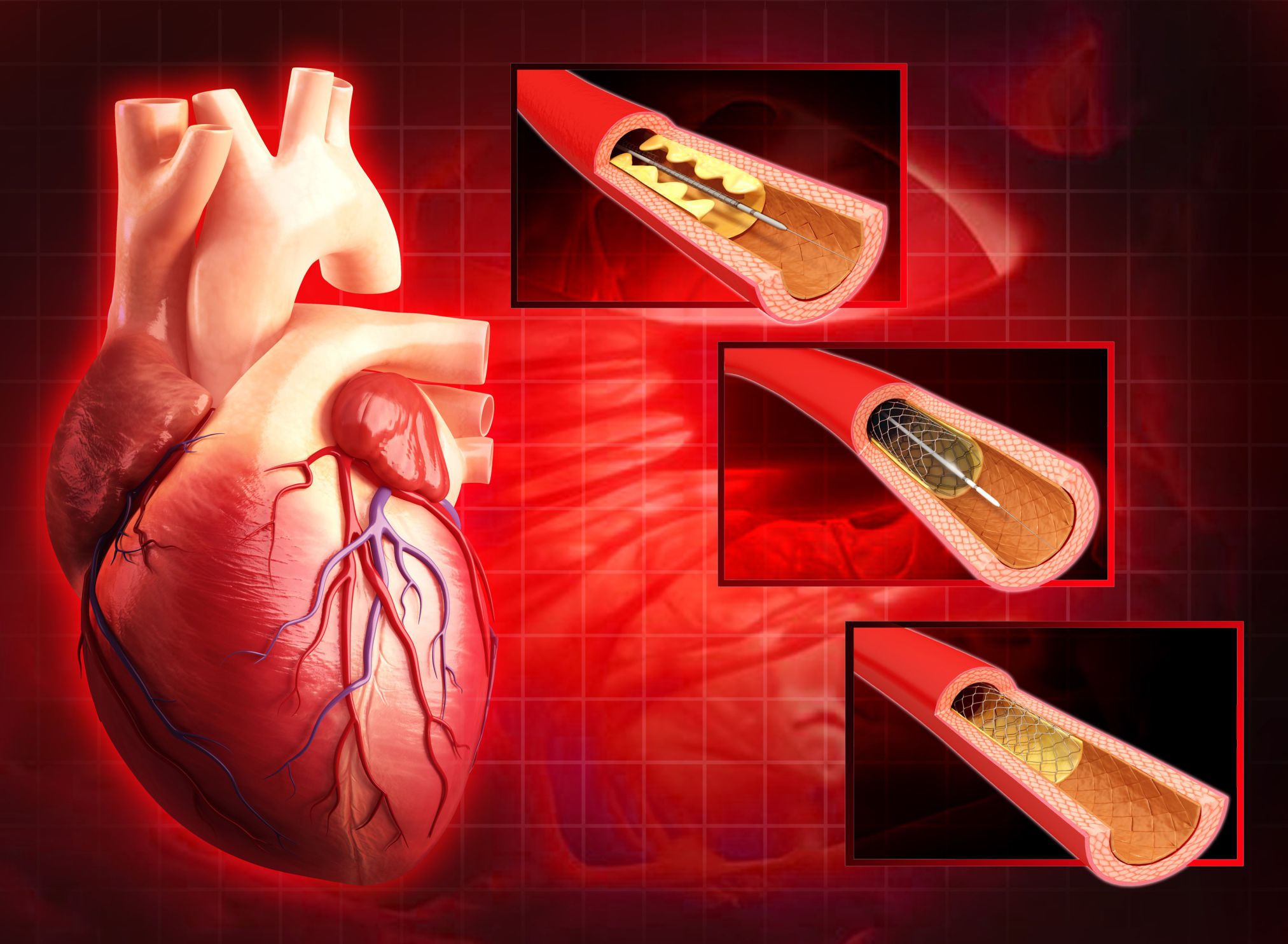 angiogram-and-coronary-angioplasty-procedure-cardiology-youtube