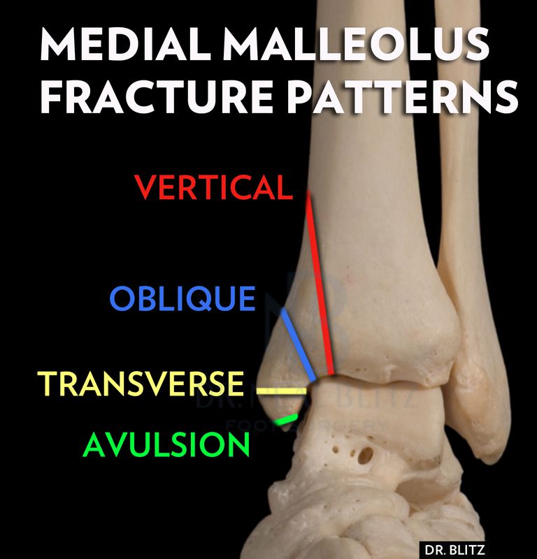 lateral malleolus of fibula