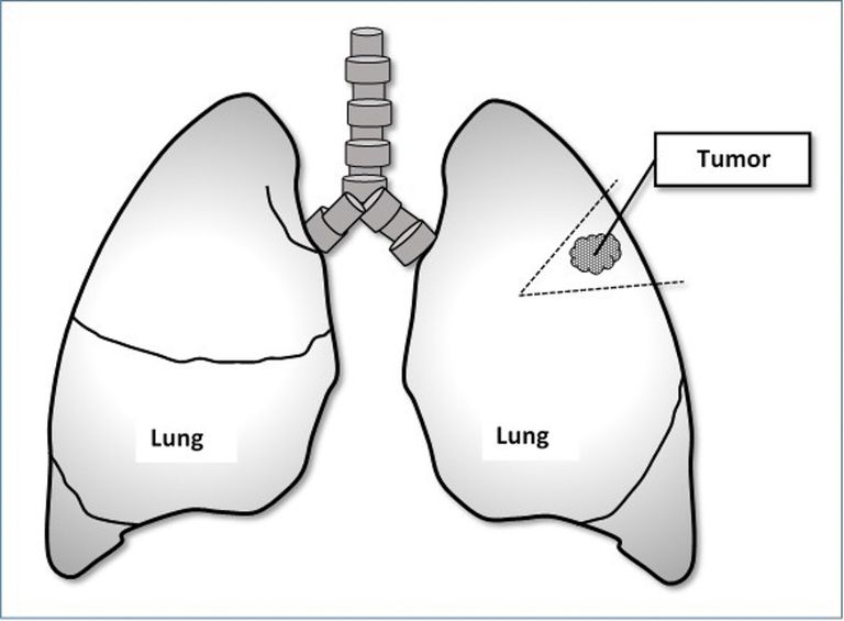 wedge-resection-for-lung-cancer