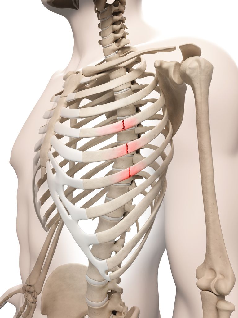 Treatment For Rib Fractures