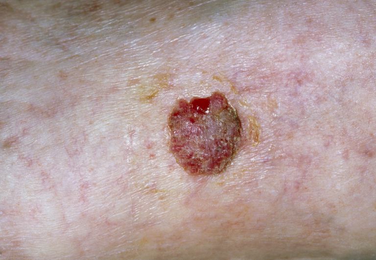 Photo Gallery of Skin Cancer by Type