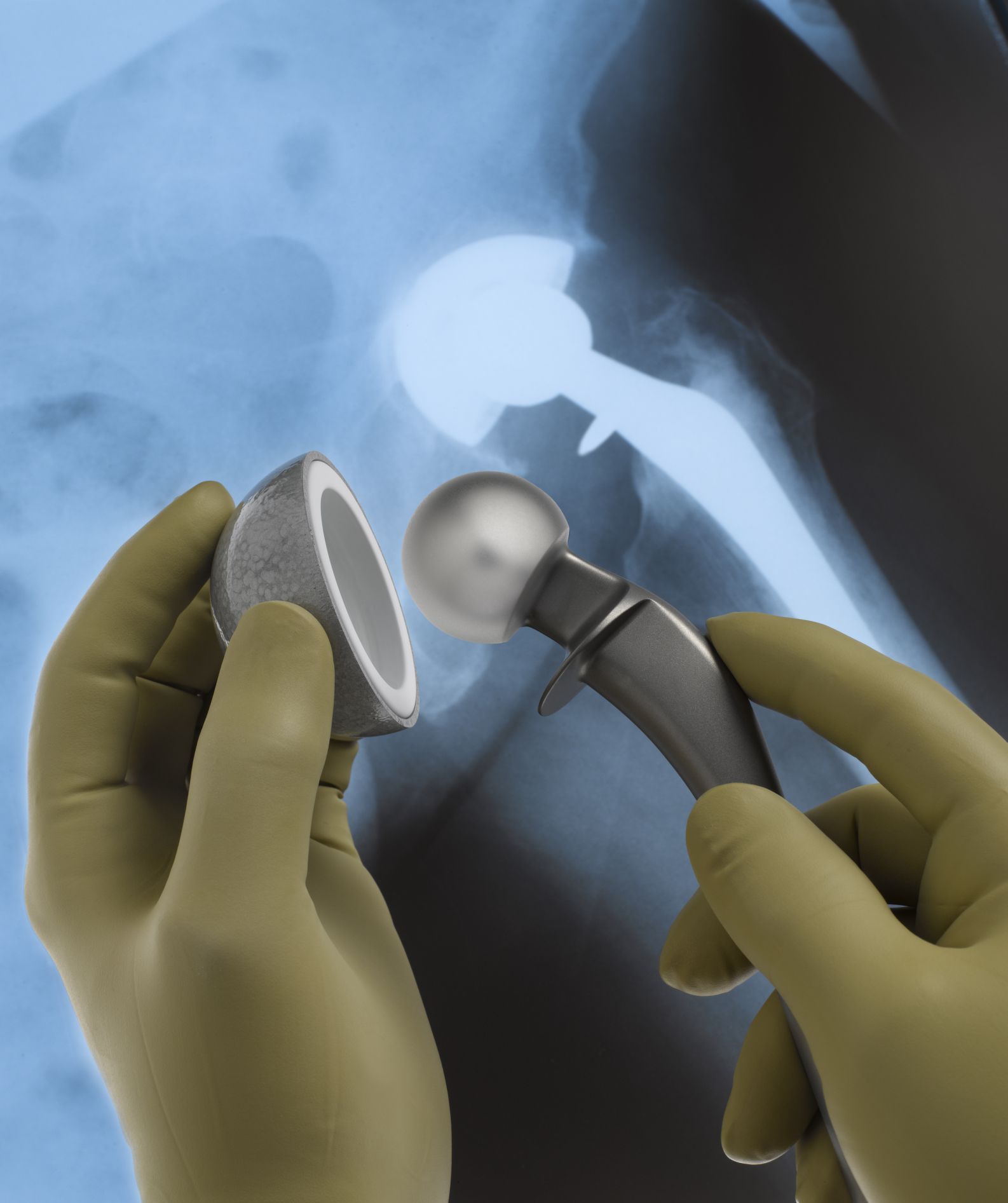 Hip replacement surgery methods