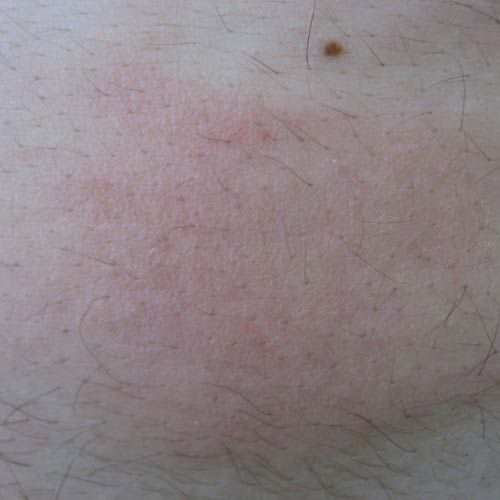 gallery-of-hives-pictures-for-identifying-rashes