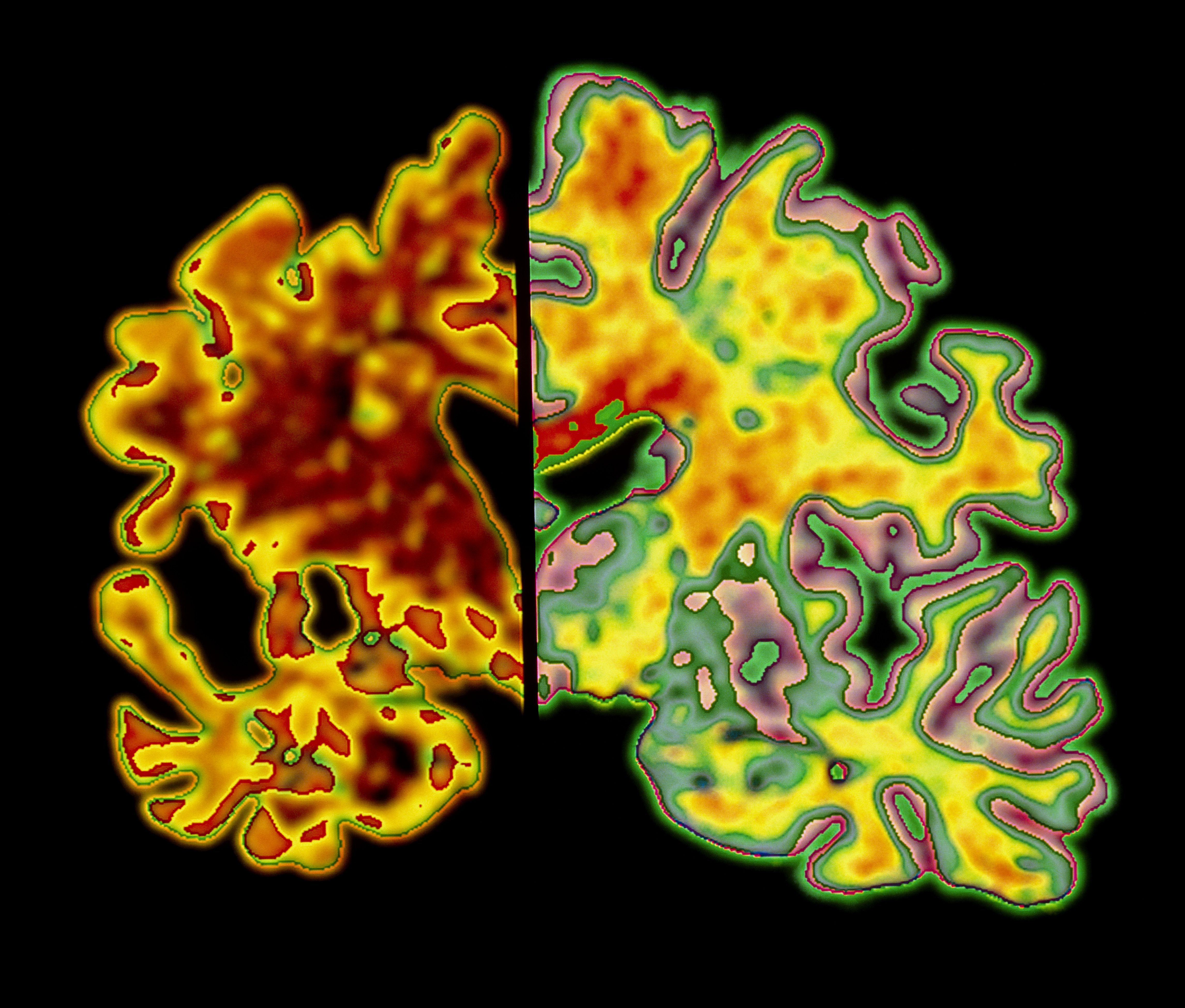 Cerebral (Brain) Atrophy And Shrinkage