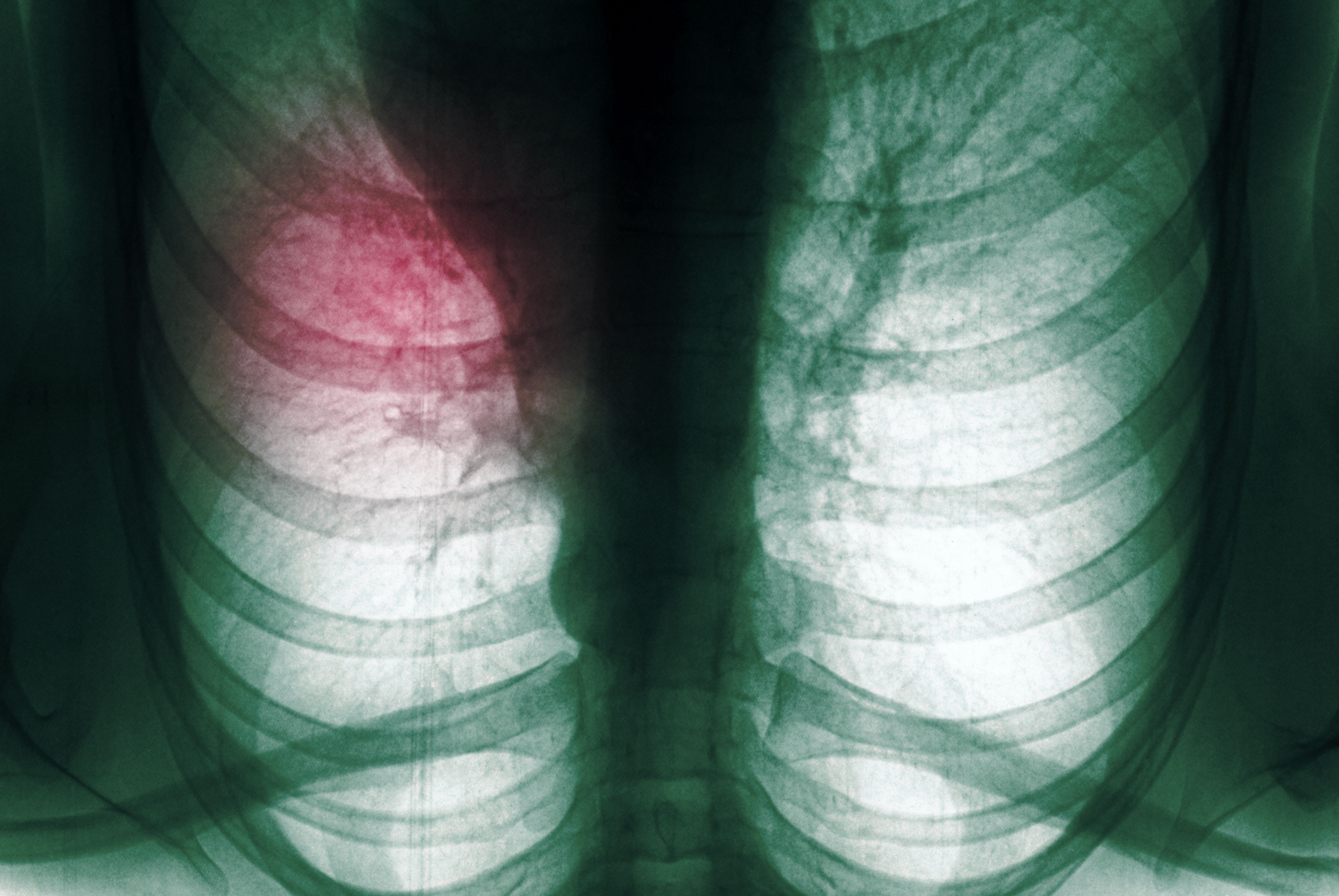 types-of-lobectomy-for-lung-cancer