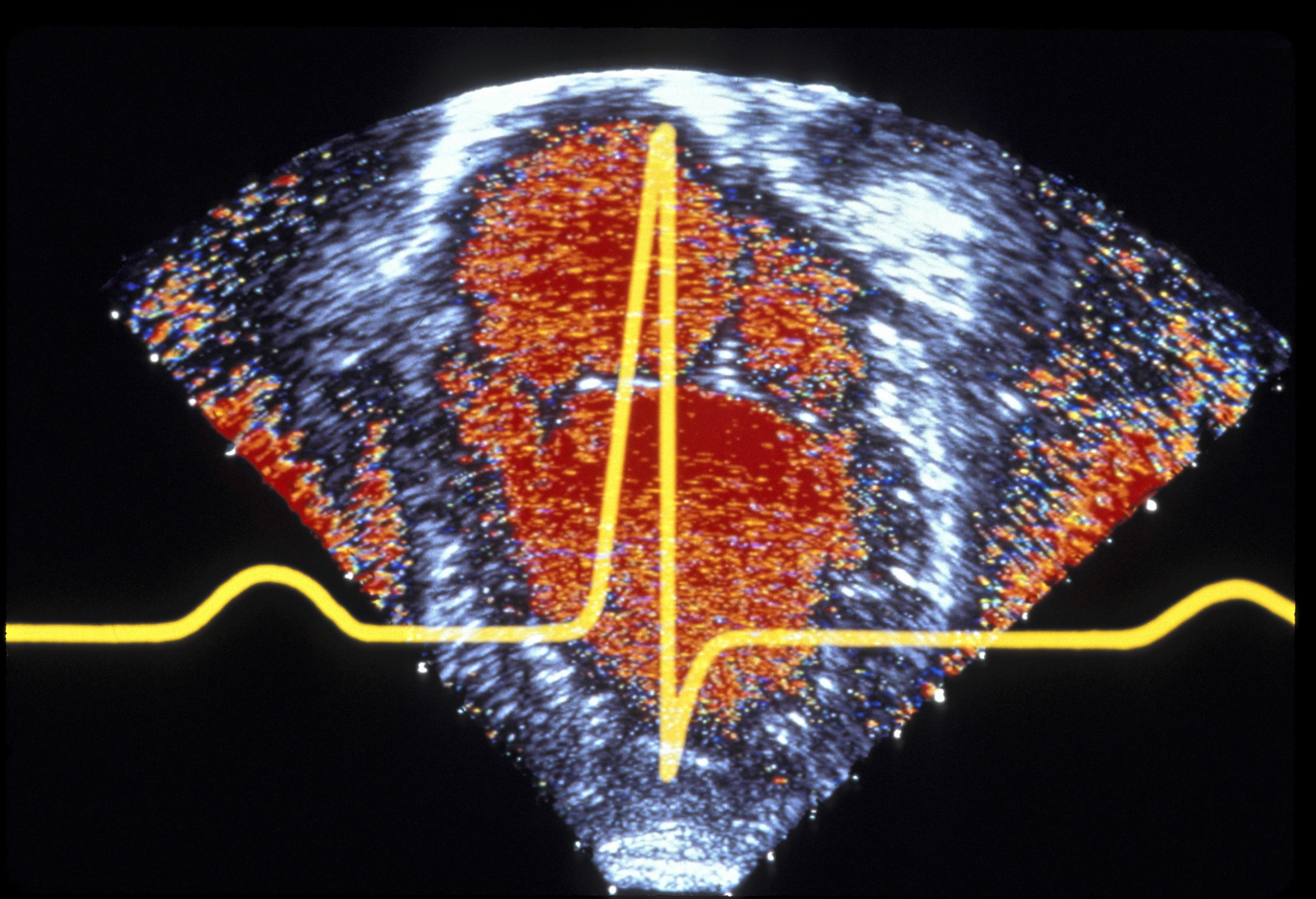 causes-and-treatment-of-rheumatic-heart-disease