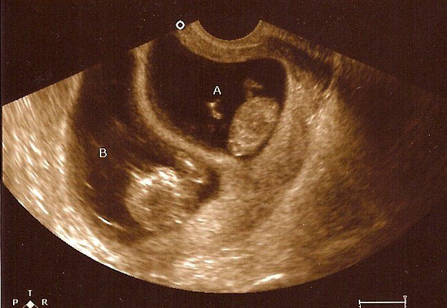 11 Weeks Pregnant Early Pregnancy First Trimester