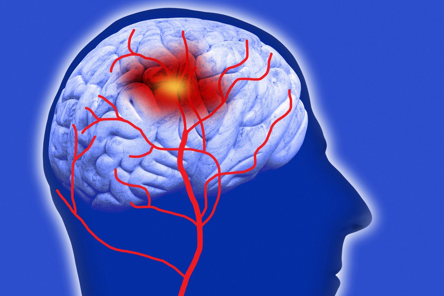 Stroke Induced Pain Is Called Dejerine Roussy Syndrome