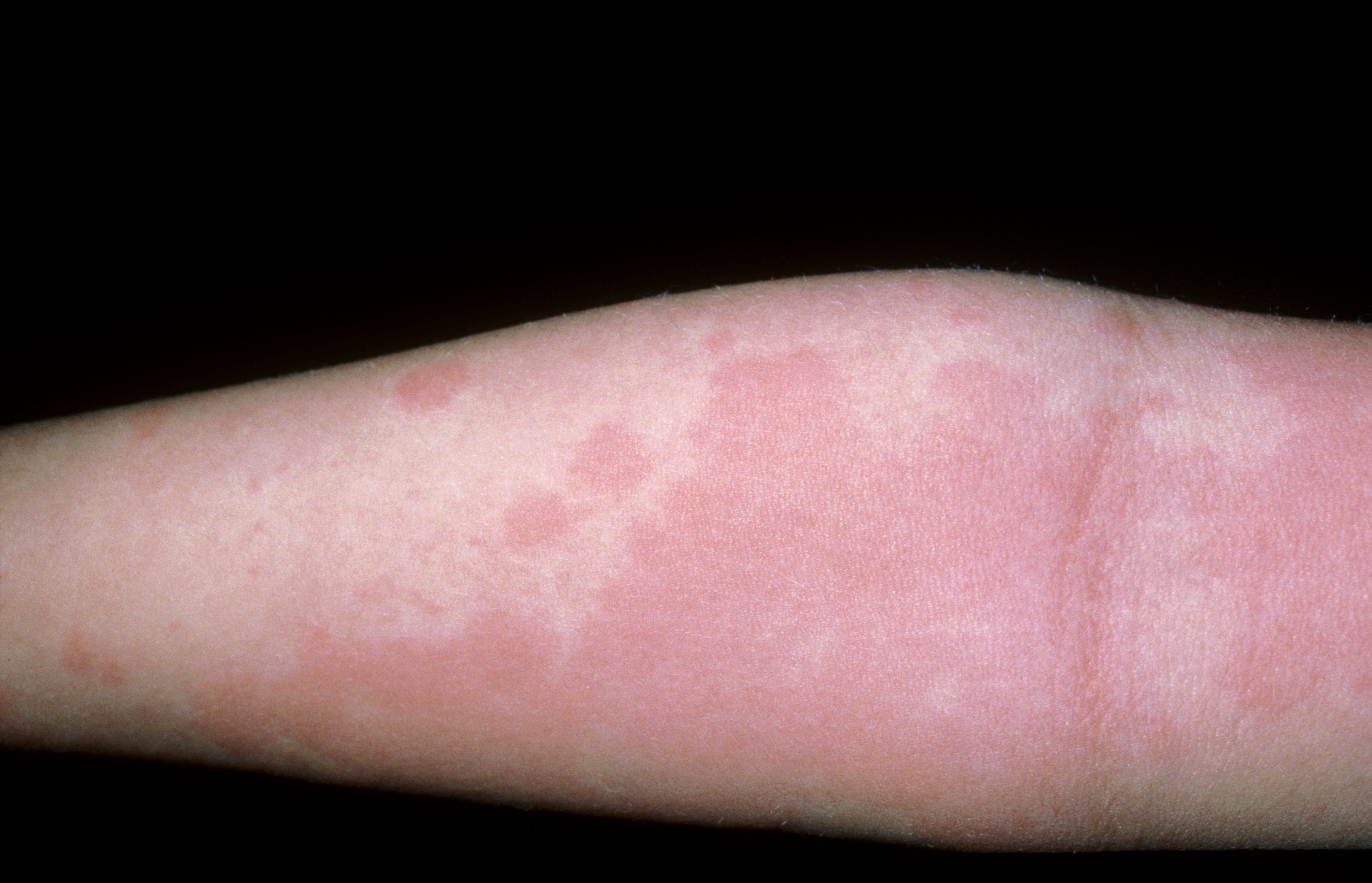 Urticaria (Hives): Causes, Symptoms, Diagnosis, and Treatment