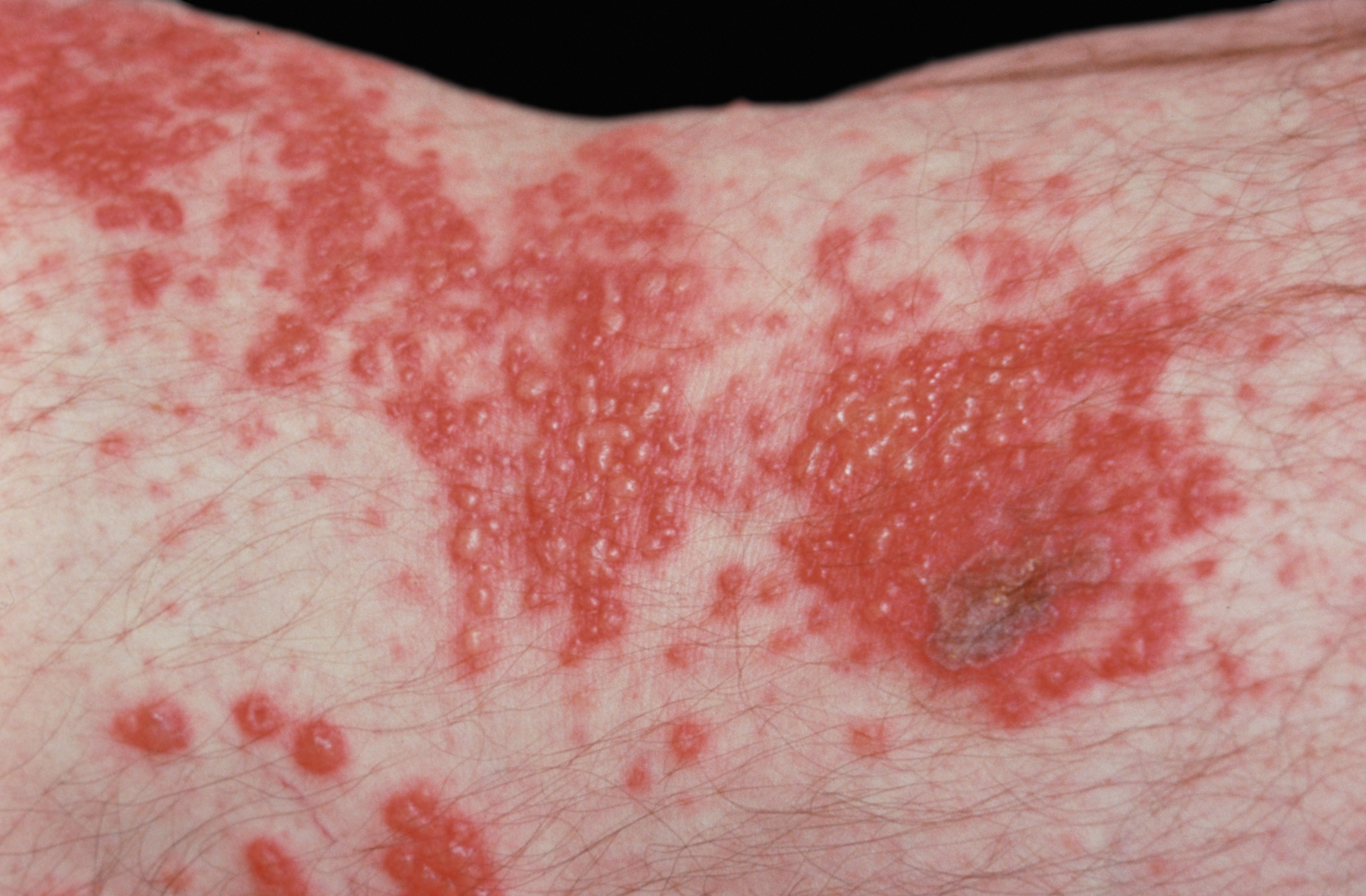 Herpes Zoster Or Shingles On A Human Arm  Vis416291 5a2da57f9e9427003768684b 
