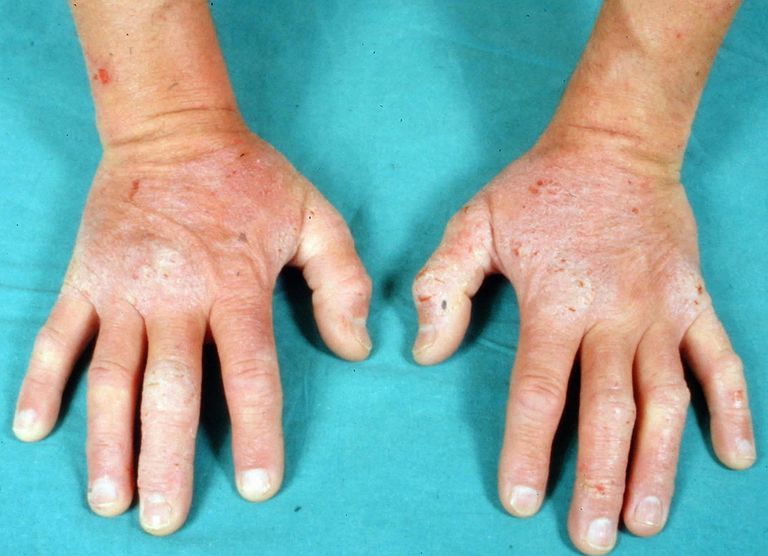 Dermatitis Herpetiformis Celiac Disease Rash Photos