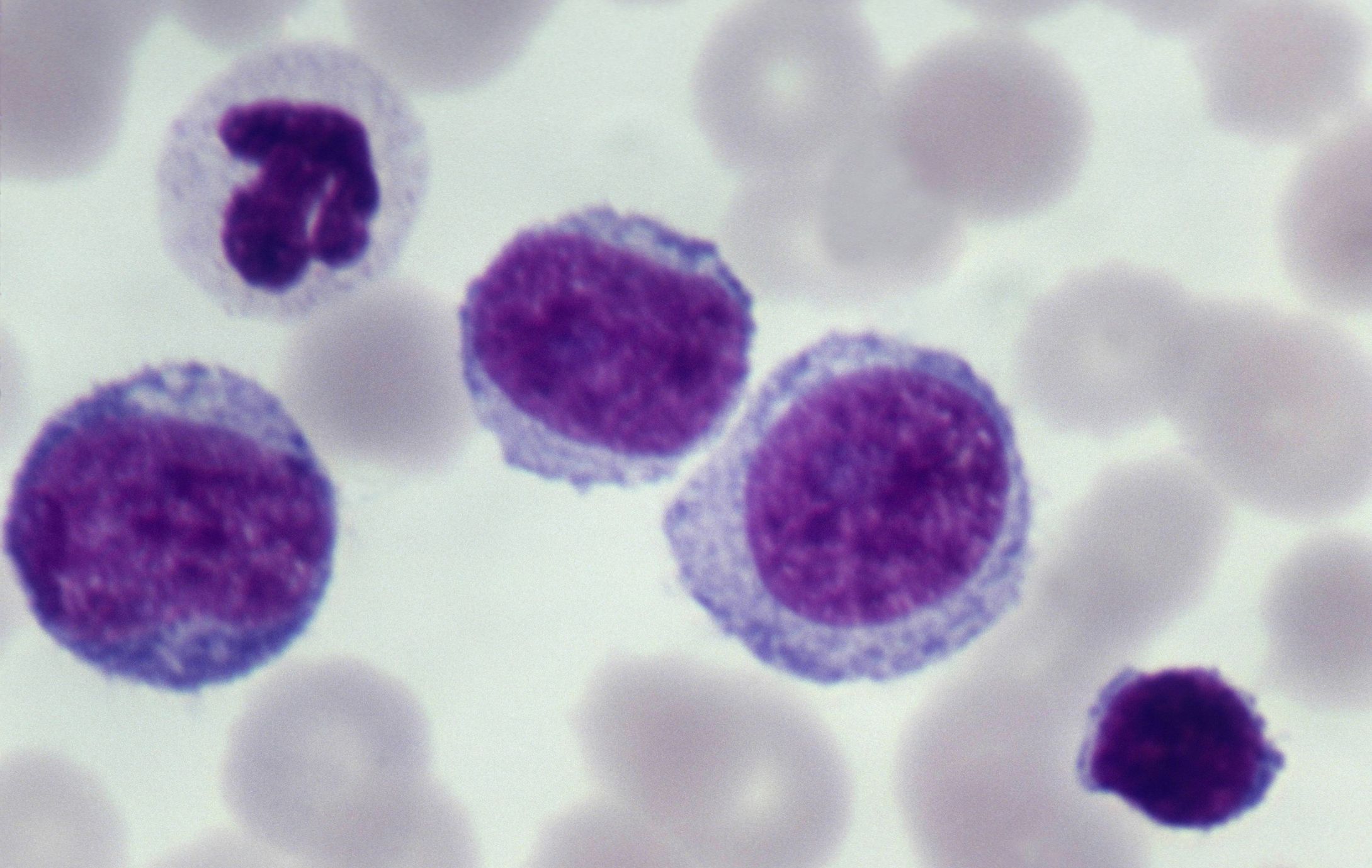 The Difference Between Acute and Chronic Leukemia
