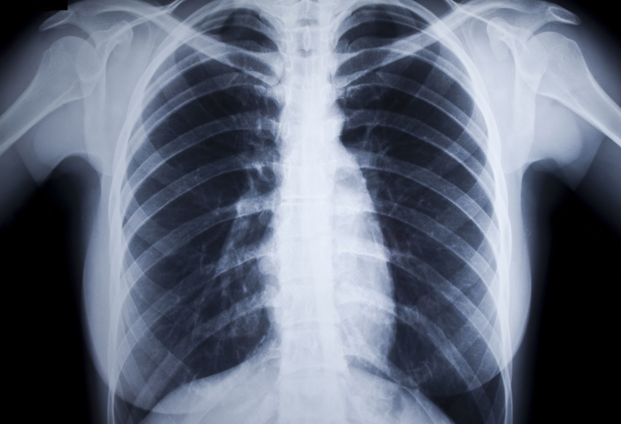 What Is Rheumatoid Lung Disease?