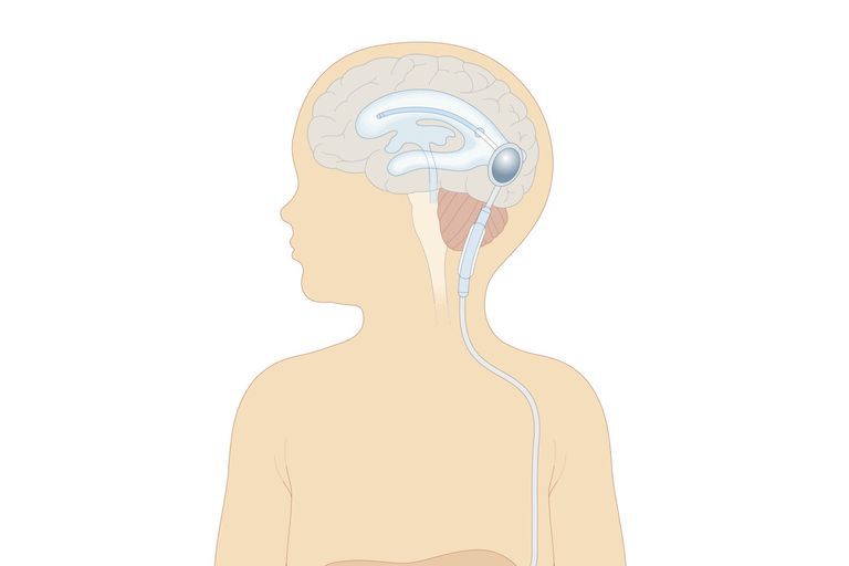 shunt-placement-for-hydrocephalus