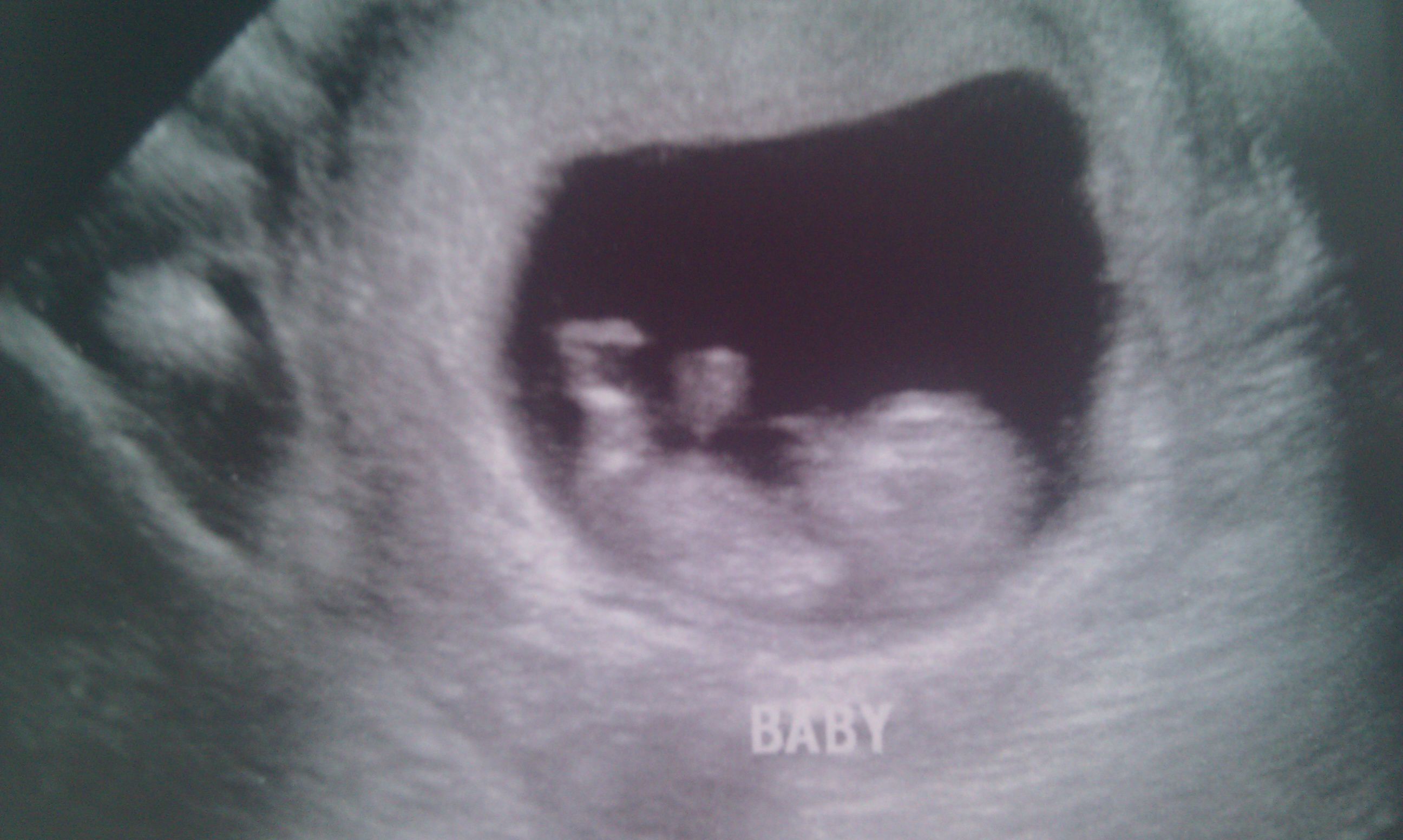 Конец 9 недели. 9-10 Недель беременности. Эмбрион на 10 неделе беременности.
