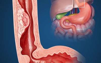 esophagus esophageal perforated jackhammer esophagitis gerd eosinophilic reflux stricture