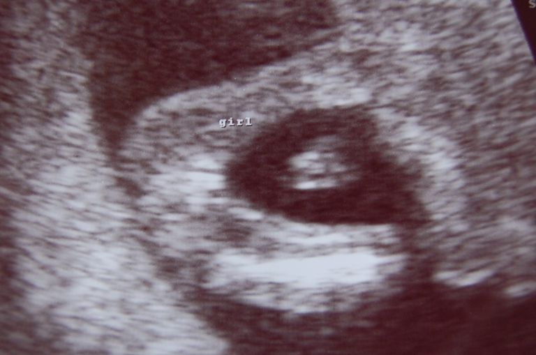 What Does a Baby Girl Look Like on Ultrasound?