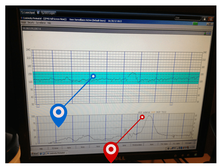 How to Read a Fetal Monitor During Labor