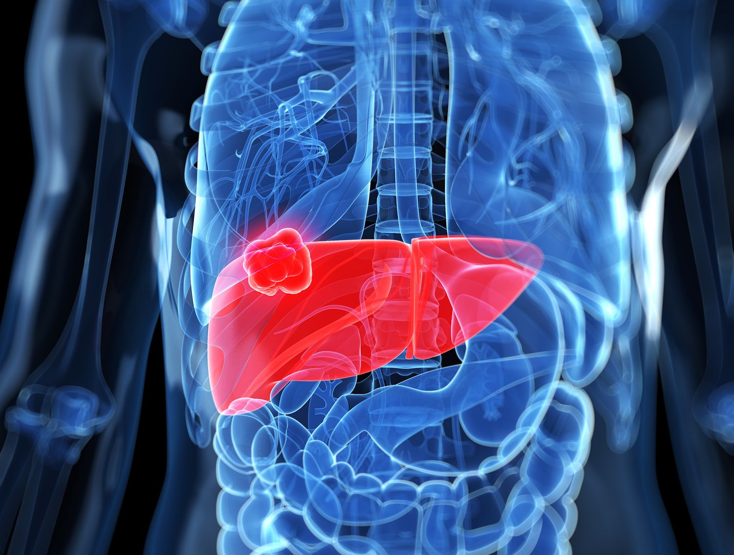 How Lung Cancer Spreads to the Liver