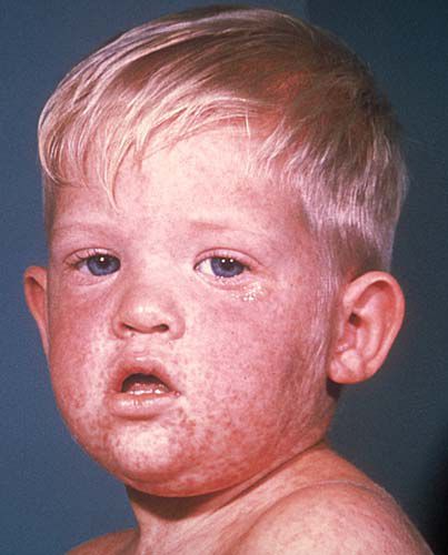 What Happens When You Get Measles in Pictures