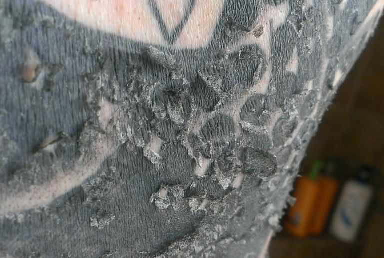Why Is My Tattoo Peeling and Flaking Off?