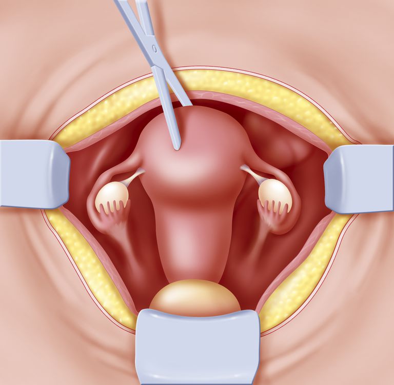 Hysterectomy Surgery Preparation And Recovery