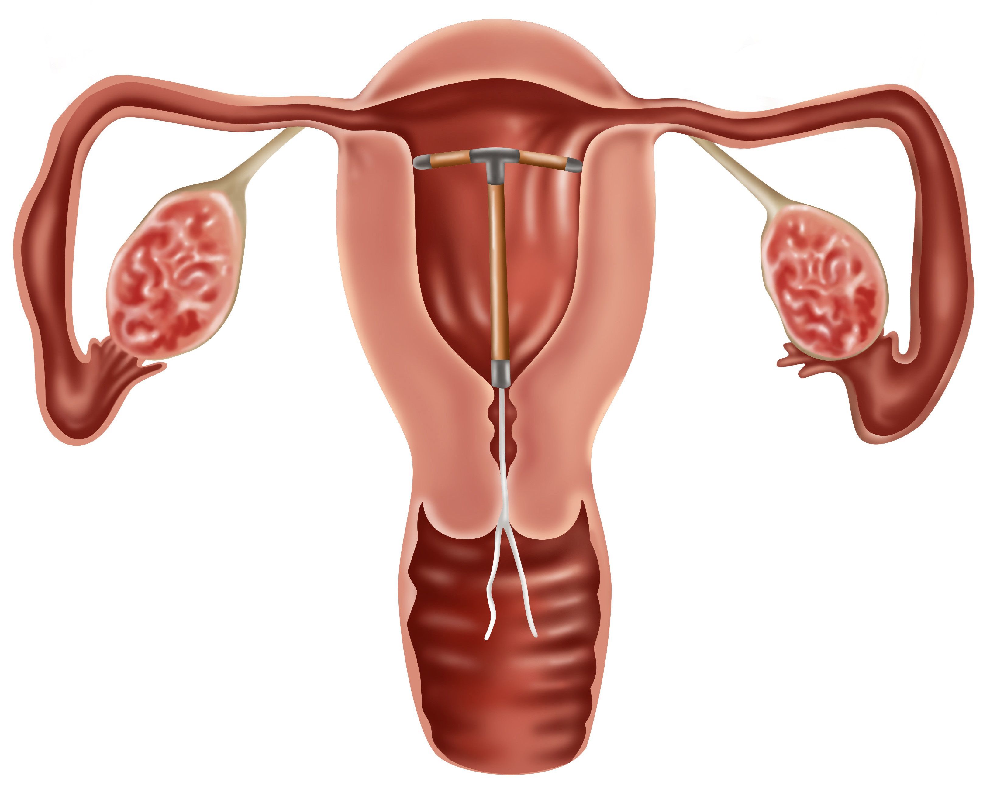 do-iuds-prevent-cervical-cancer