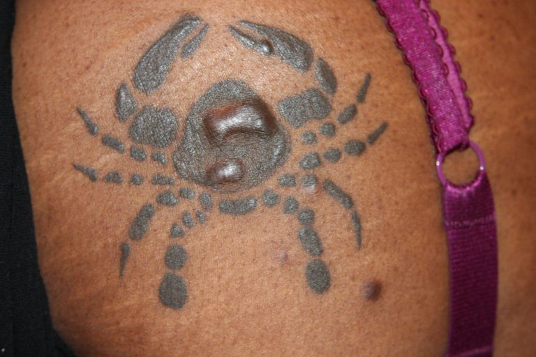 Tattoos and Keloids What to Do if You Have a Keloid