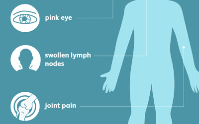 Meningitis: Signs, Symptoms and Complications