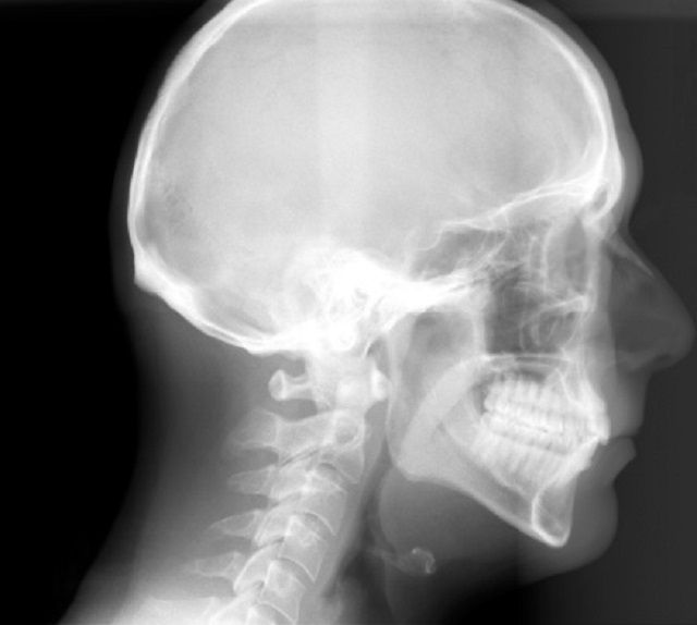 What Is a Cephalometric or Ceph X-Ray Used For?