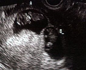 10th Week Pregnancy Ultrasound Photos