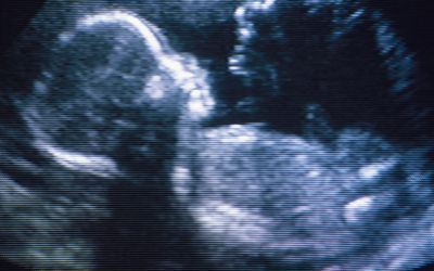 how accurate is your due date by ultrasound