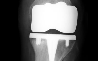 The Facts About Total Knee Replacement Surgery