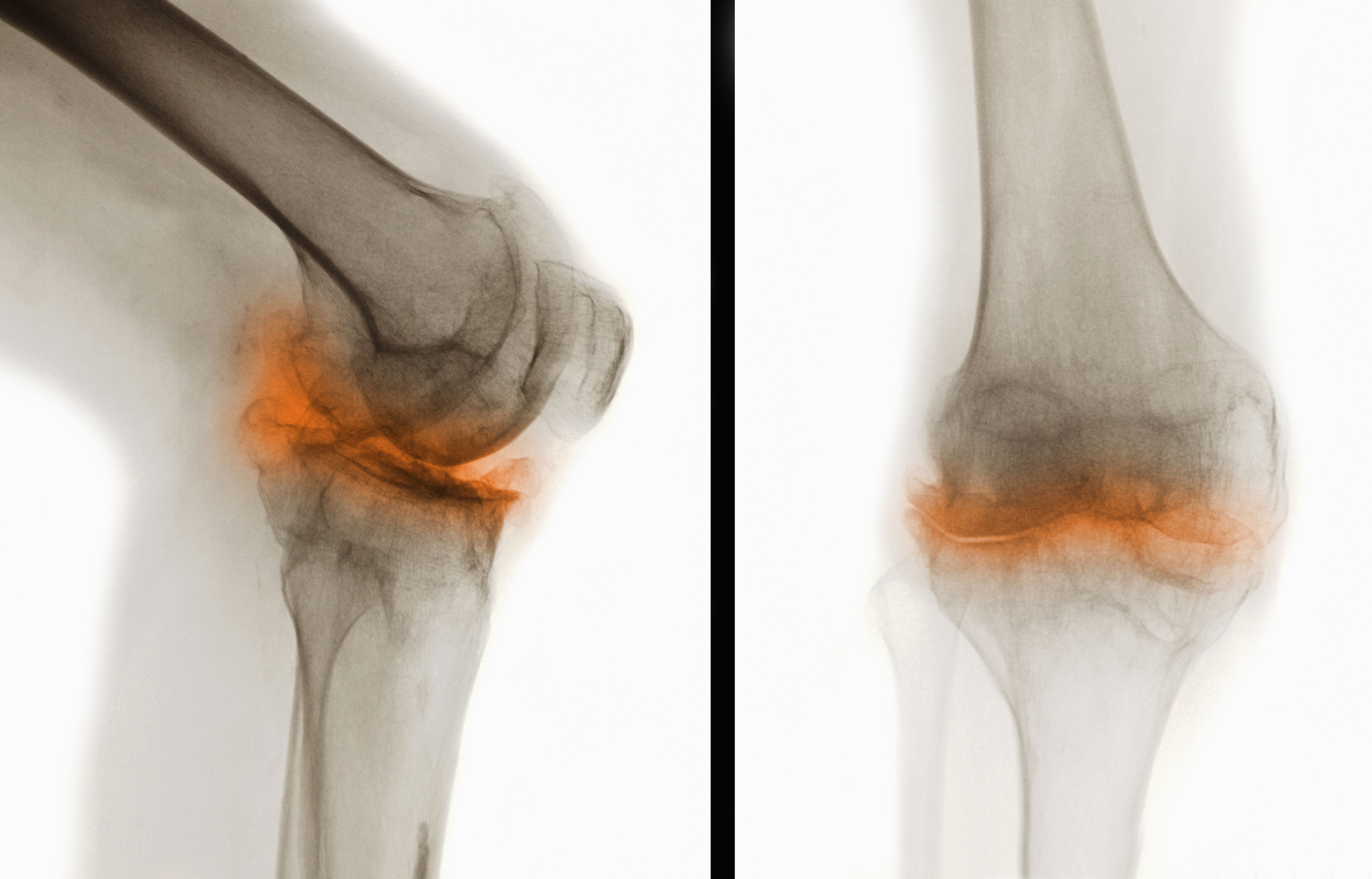 Two X Ray Radiograph Views Of Male 44 Year Old Knee With Severe Degenerative Osteoarthritic Changes 123534572 599da7dad088c0001096df6c 